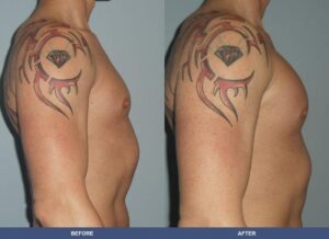 Gregory Pectoralimp Side