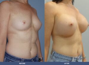 Hancock Ba A2d Oblique