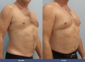 Harris Pectoralimp Oblique