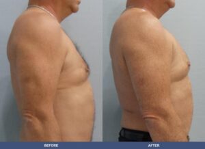 Harris Pectoralimp Side