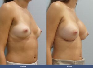 Heidersberger Ba B2d Oblique