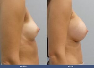 Heidersberger Ba B2d Side