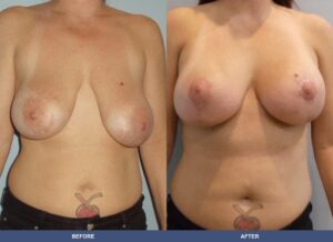 Howard Bal Pexy Front