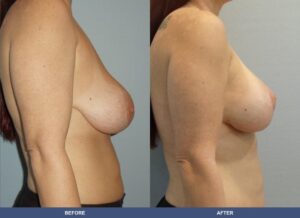 Howard Bal Pexy Side