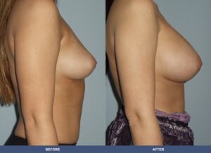 Hunsinger Ba B2d Side