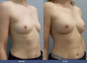 Jackson304 Ba A2b Oblique