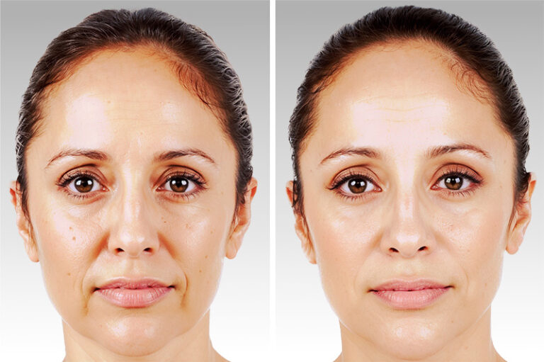 Juvederm Fillers