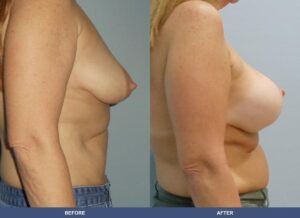 Ladd Hoffman Bal Pexy Side