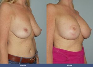 Leedy Bal Pexy Oblique