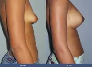 Mckenzie Ba A2c Side