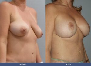 Mendez Bal Pexy Oblique