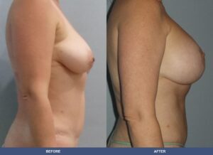 Mendez Bal Pexy Side