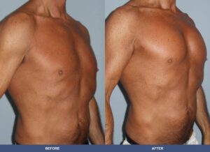 Paglia Pectoralimp Oblique