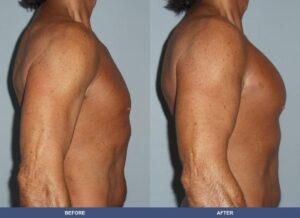 Paglia Pectoralimp Side