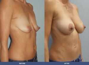 Rodgers Bal Pexy Oblique