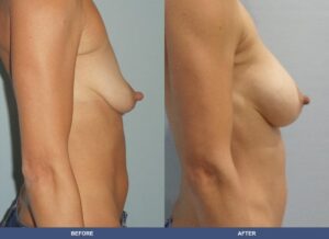 Rodgers Bal Pexy Side