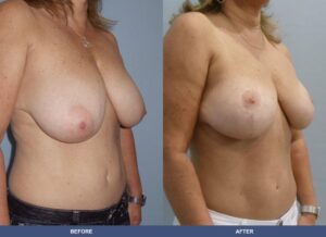 Romanelli Br Oblique