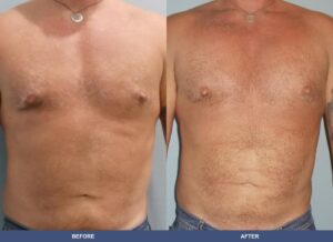 Shon Pectoralimp Front