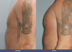 Shon Pectoralimp Side