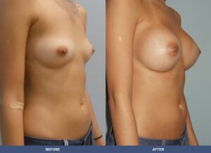 Souza Ba A2c Oblique