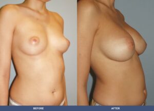 Suarez Ba B2c Oblique