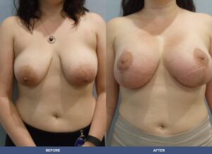 Suarez Bal Pexy Front