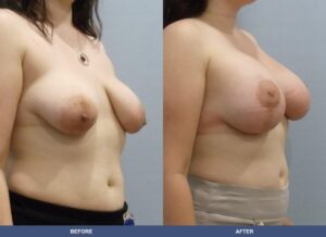 Suarez Bal Pexy Oblique