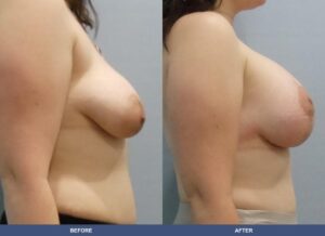 Suarez Bal Pexy Side