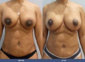 Tambling Bal Pexy Lipo Front