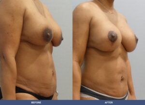 Tambling Bal Pexy Lipo Oblique