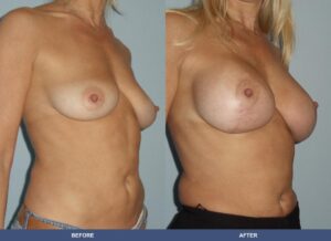 Tenaglia Bal Pexy Oblique