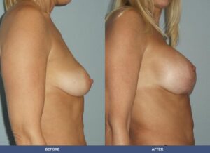 Tenaglia Bal Pexy Side