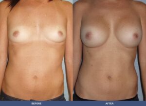 White339 Ba A2b Front