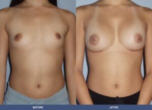 Wongpanich Ba A2b Front