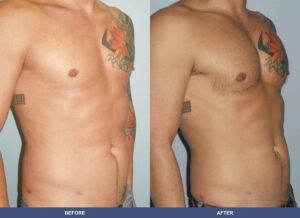 Woodard Pectoralimp Oblique