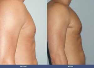 Woodard Pectoralimp Side