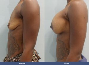 Yeargin Bal Pexy Side