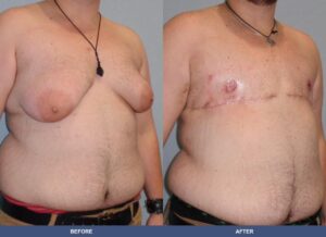 York Ftm Oblique